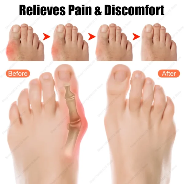 Bunion Corrector Unisex Foot Hallux Valgus Braces Toe Separator Straightener Adjustable Pedicure Finger Toe Corrector Strap Self - Image 4